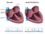 Atrial Fibrillation Classification